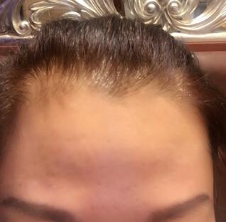 去抬头纹很好的方法是注射注射瘦脸