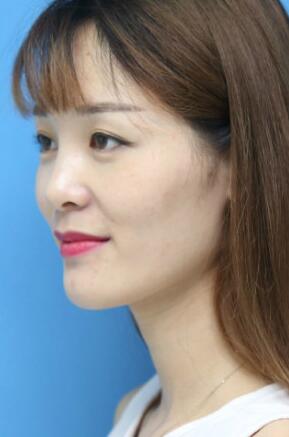 玻尿酸丰太阳穴对比照片和恢复过程分享