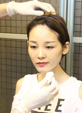 玻尿酸丰太阳穴对比照片和恢复过程分享