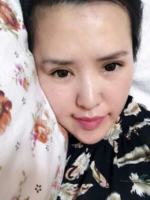 全切双眼皮修复恢复后图片，宽度较为合适哟