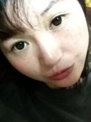 激光去雀斑果好不好，真实案例告诉你