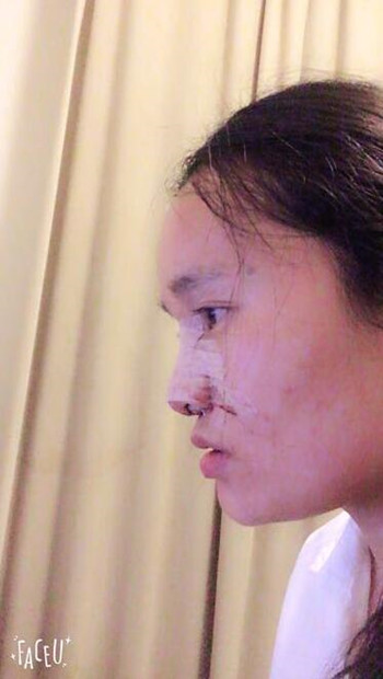 隆鼻整形手术让我晋升女神行列 果真的很不错哦