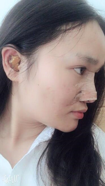 隆鼻整形手术让我晋升女神行列 果真的很不错哦