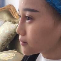 玻尿酸填充卧蚕果对比图，很满意