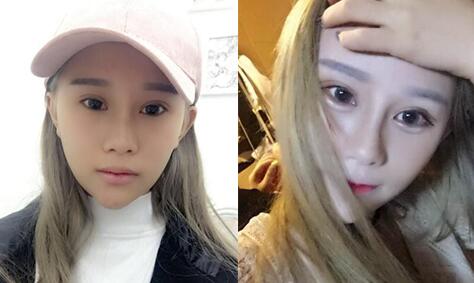 玻尿酸填充卧蚕前后的对比图