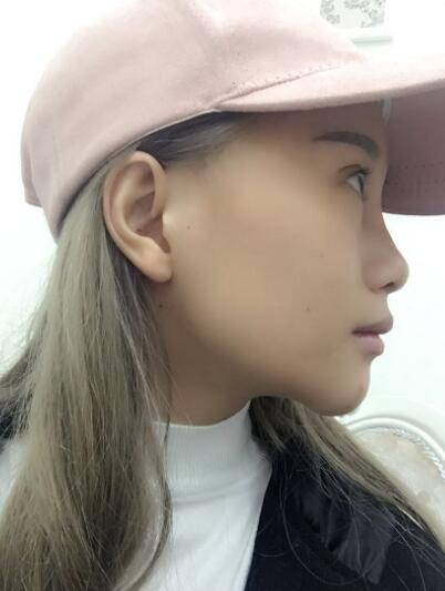 玻尿酸填充卧蚕