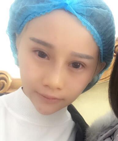 玻尿酸填充卧蚕果对比图