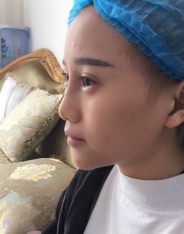 玻尿酸填充卧蚕果对比图