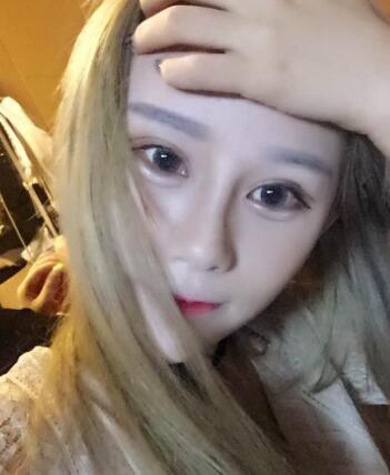 玻尿酸填充卧蚕果对比图