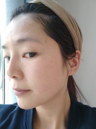 做完光子嫩肤恢复图片和过程分享，光子嫩肤价格3800元