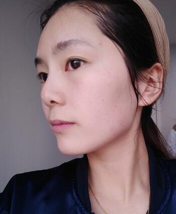 做完光子嫩肤恢复图片和过程分享，光子嫩肤价格3800元