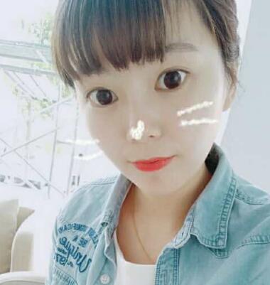 做完光子嫩肤恢复图片和过程分享，光子嫩肤价格3800元