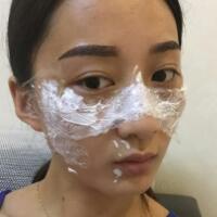 有谁做过激光祛雀斑？个人激光祛雀斑后恢复日记分享