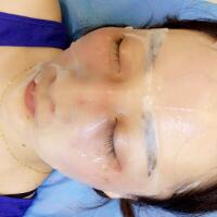 有谁做过激光祛雀斑？个人激光祛雀斑后恢复日记分享