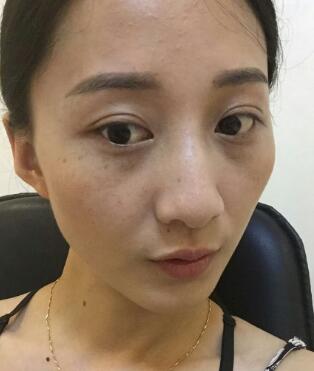 有谁做过激光祛雀斑？个人激光祛雀斑后恢复日记分享