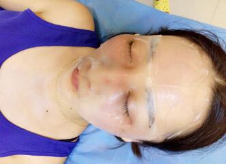 有谁做过激光祛雀斑？个人激光祛雀斑后恢复日记分享