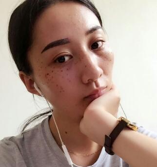 有谁做过激光祛雀斑？个人激光祛雀斑后恢复日记分享