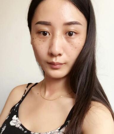 有谁做过激光祛雀斑？个人激光祛雀斑后恢复日记分享