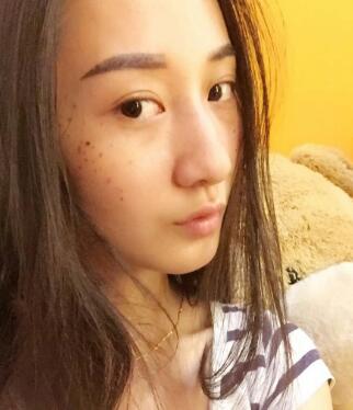 有谁做过激光祛雀斑？个人激光祛雀斑后恢复日记分享