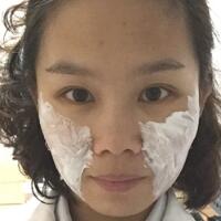 玻尿酸去法令纹后人变年轻了好几岁