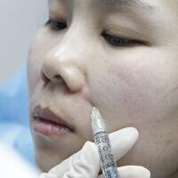 玻尿酸去法令纹后人变年轻了好几岁