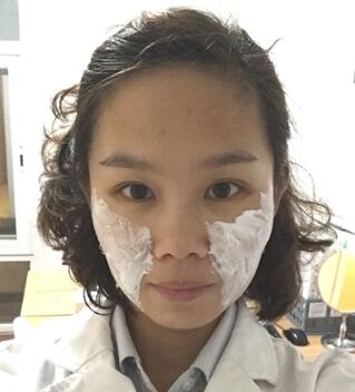 玻尿酸去法令纹后人变年轻了好几岁