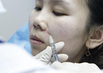 玻尿酸去法令纹后人变年轻了好几岁