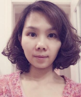 玻尿酸去法令纹后人变年轻了好几岁