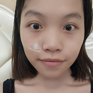 海口红妆李杰医生给我做的激光点痣，分享一下前后对比图片