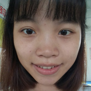 海口红妆李杰医生给我做的激光点痣，分享一下前后对比图片