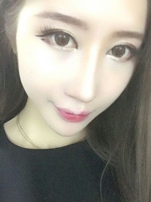 自体脂肪填充面部前后对比果图分享，海南瑞韩徐春梅做的