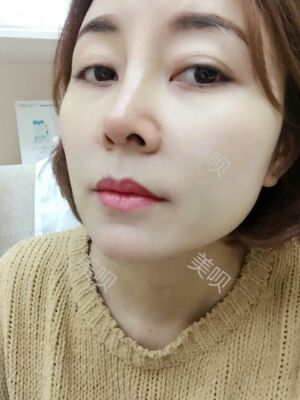 成都隆鼻整形整真实恢复图片，终于有了韩式小翘鼻