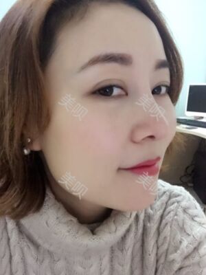 成都隆鼻整形整真实恢复图片，终于有了韩式小翘鼻