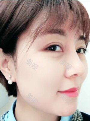 成都隆鼻整形整真实恢复图片，终于有了韩式小翘鼻