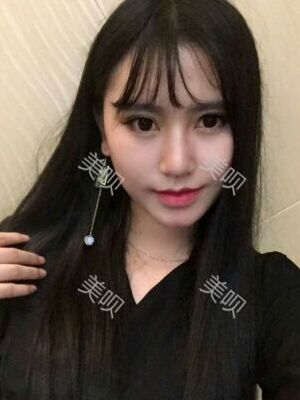 线D隆鼻恢复过程图片，真实案例照片