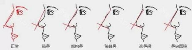 鼻型介绍，上海艺星整形美容医院整形价格表大曝光
