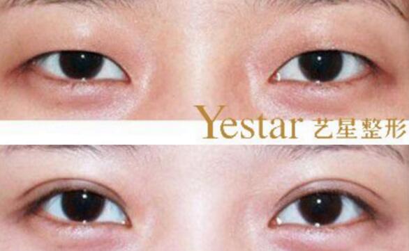 割双眼皮整形图片，上海艺星整形美容医院整形价格表大曝光