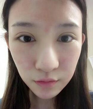 隆鼻失败修复后恢复图分享，鼻子修复价格9800元