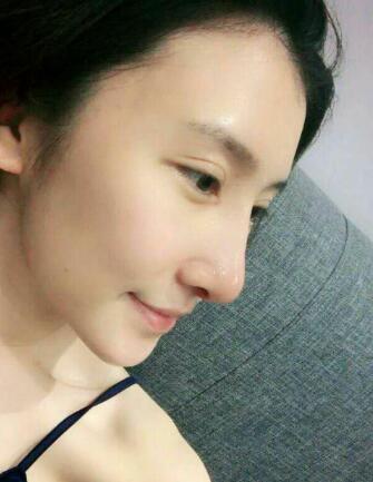 隆鼻失败修复后恢复图分享，鼻子修复价格9800元