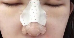 隆鼻失败修复后恢复图分享，鼻子修复价格9800元