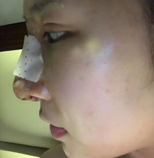 隆鼻失败修复后恢复图分享，鼻子修复价格9800元