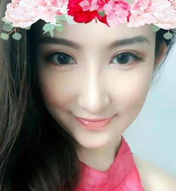 隆鼻失败修复后恢复图分享，鼻子修复价格9800元