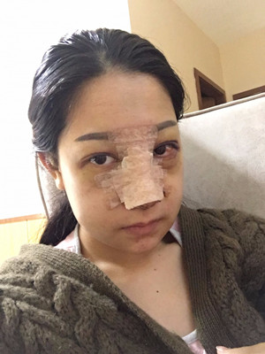 海南瑞韩刘申松做的隆鼻整形手术，附上前后对比图片
