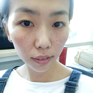 激光祛晒斑真实案例分享，并附上前后对比图片