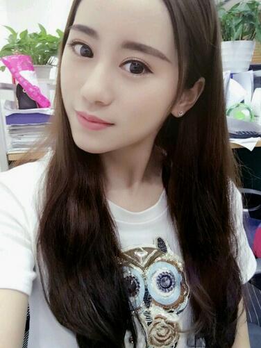 割双眼皮案例图片 双眼皮手术20天