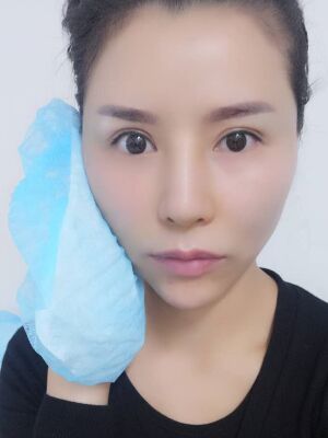 脸部埋埋蛋白线.提升果图，真实经历分享