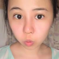 鼻部综合整形恢复过程图分享