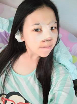 鼻部综合整形恢复过程图分享