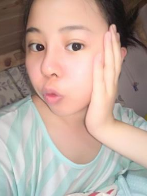 鼻部综合整形恢复过程图分享