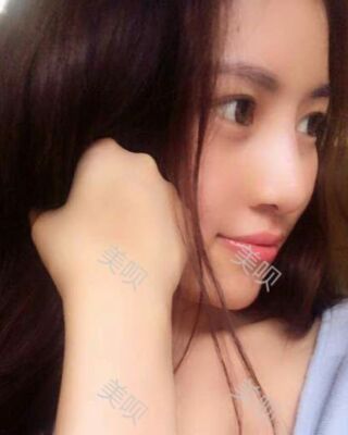 福州爱美尔假体隆鼻失败后成功修复果图